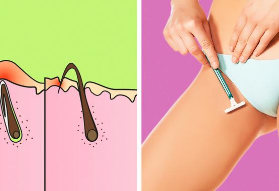 How to Get Rid of Ingrown Hair and Avoid Getting It