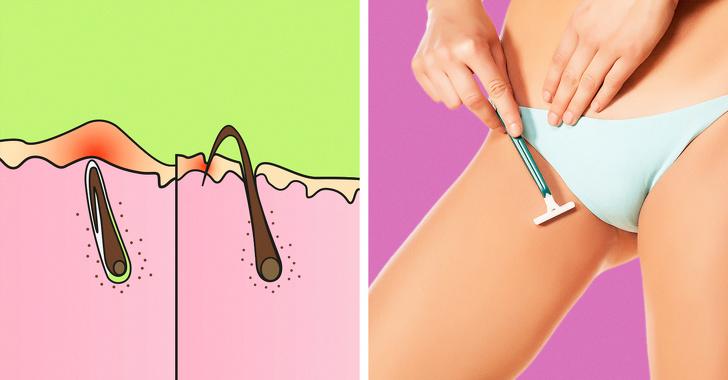 How to Get Rid of Ingrown Hair and Avoid Getting It