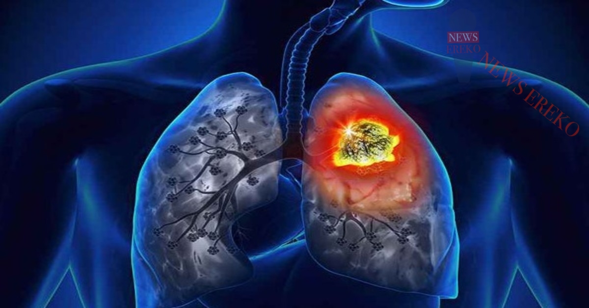 Թոքերի քաղցկեղ. ի՞նչ ախտանիշ է առաջանում քայլելու ժամանակ