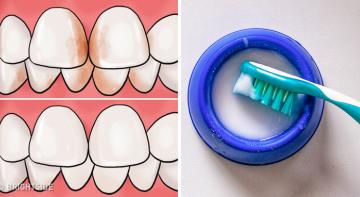 10 Ways to Remove Tartar Stains From Your Teeth